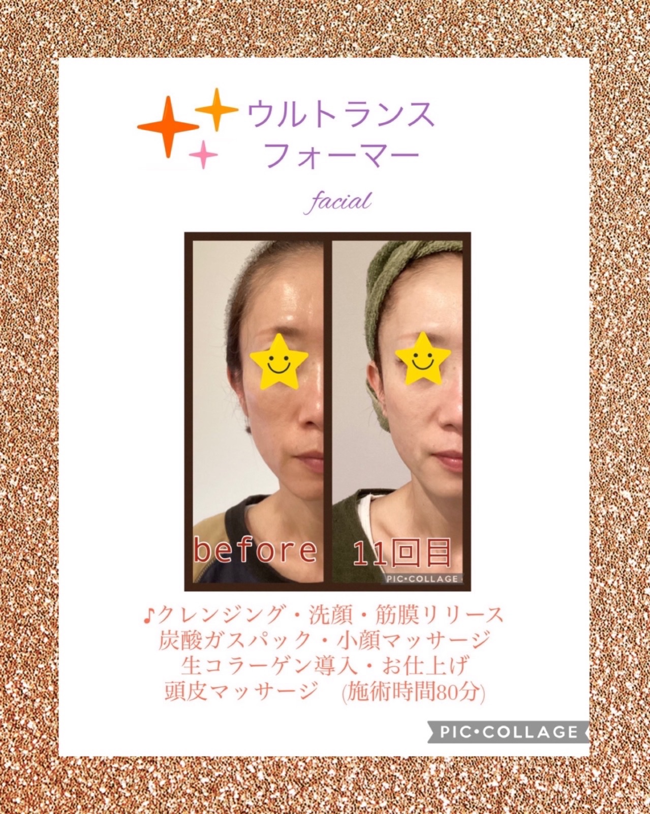 ウルトランスフェイシャル