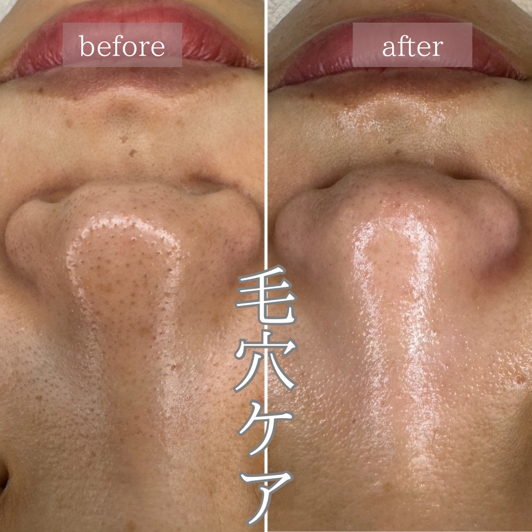 鼻角栓吸引ケア＋剃り