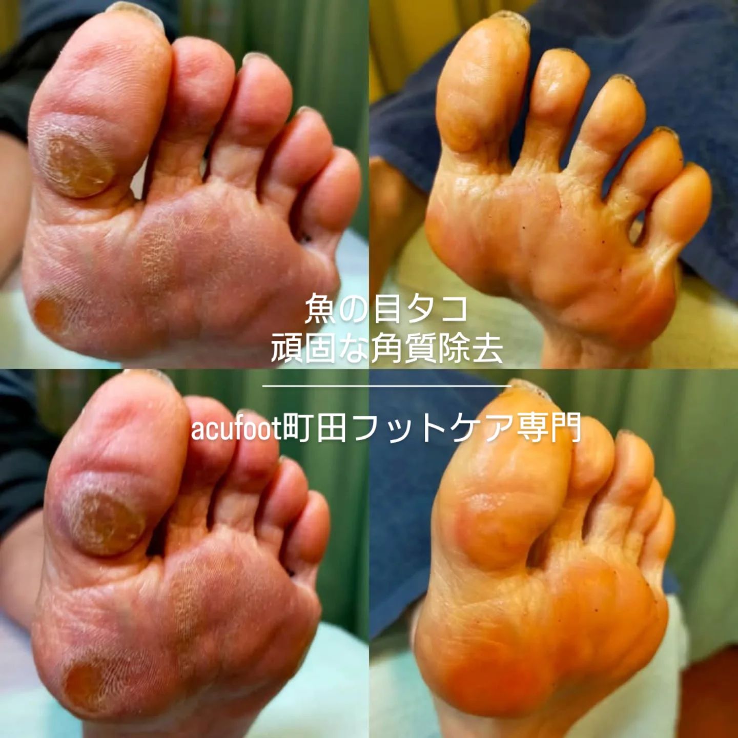 acufoot 町田フットケア専門の写真 9